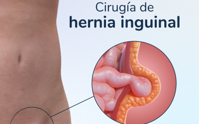 Hernia inguinal: causas, síntomas y tratamiento