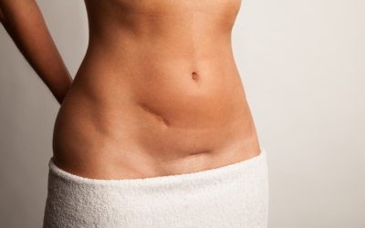 Hernia inguinal en mujeres: señales a tener en cuenta