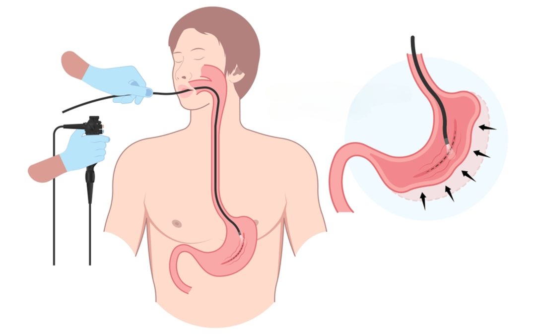 Gastroplastía endoscópica y cómo puede tratar la obesidad